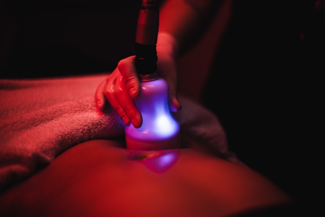 iCRYO Fairfield Cryosculpting body sculpting session